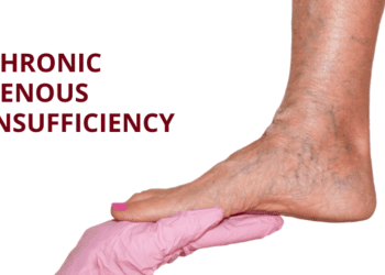 Chronic Venous Insufficiency