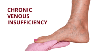 Chronic Venous Insufficiency