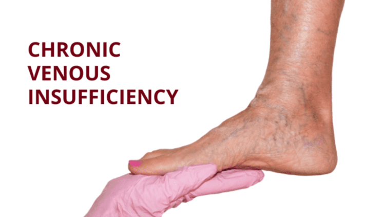 Chronic Venous Insufficiency