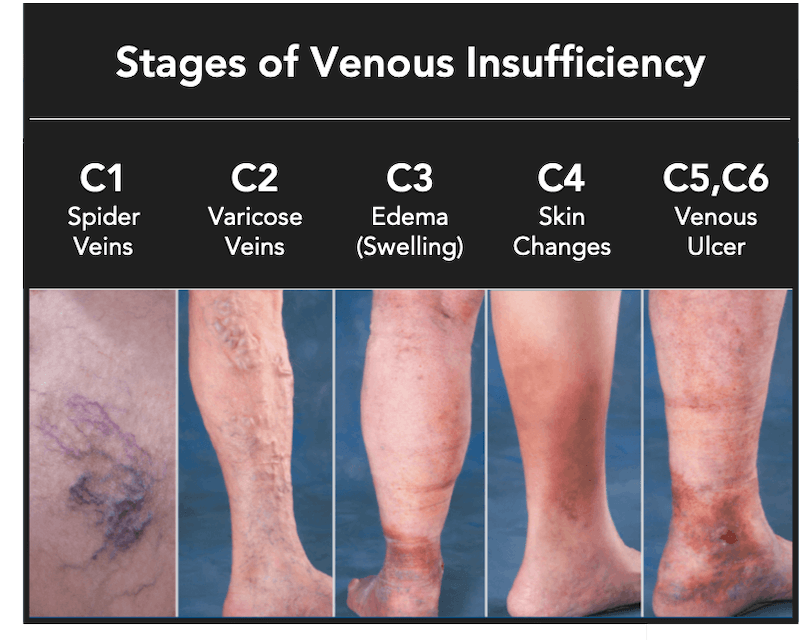 Chronic Venous Insufficiency