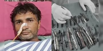Doctors Shocked After Finding 50 Objects Inside Man’s Stomach During Surgery
